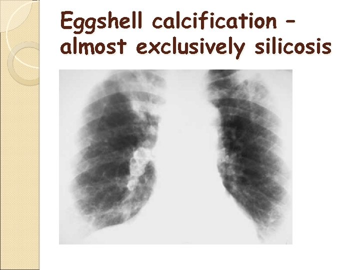Eggshell calcification – almost exclusively silicosis 