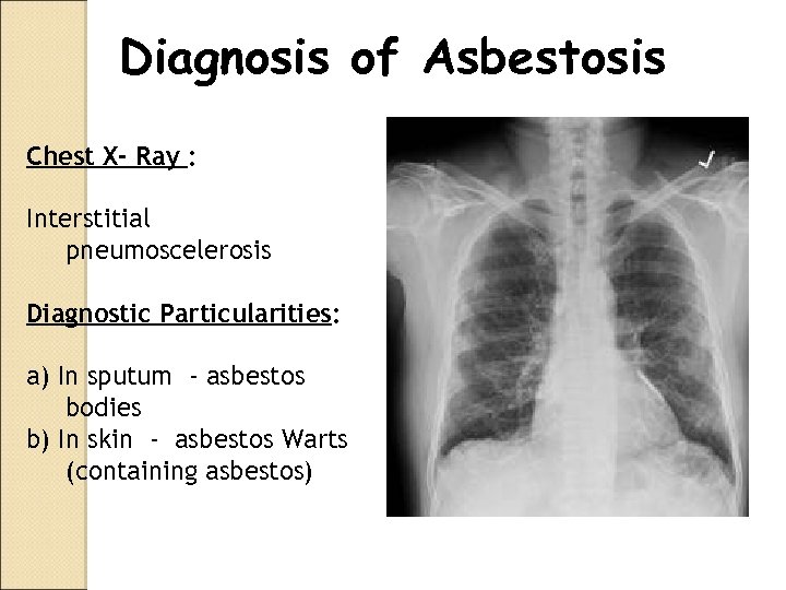 Diagnosis of Asbestosis Chest X- Ray : Interstitial pneumoscelerosis Diagnostic Particularities: a) In sputum