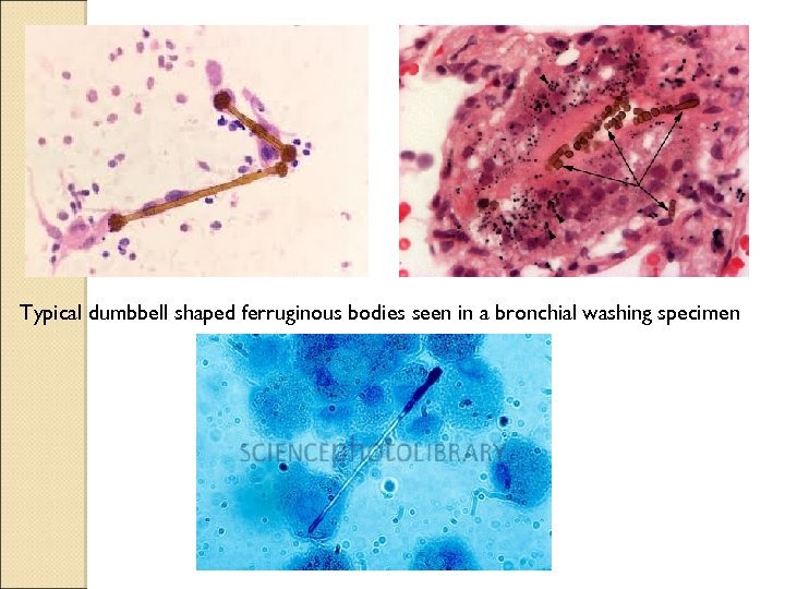 Typical dumbbell shaped ferruginous bodies seen in a bronchial washing specimen 