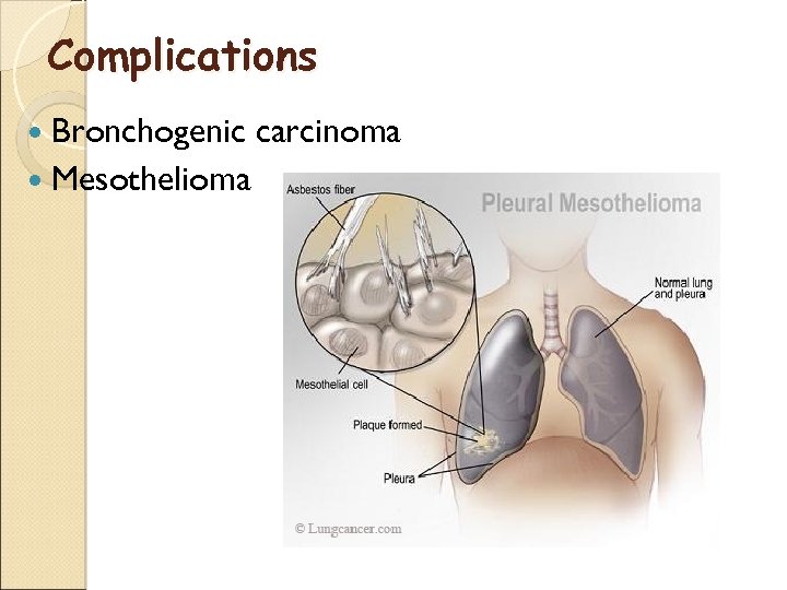 Complications Bronchogenic Mesothelioma carcinoma 