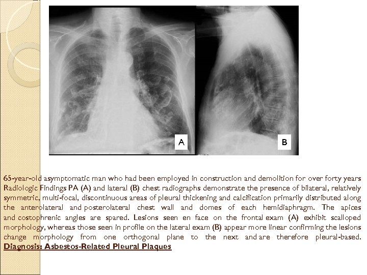 A B 65 -year-old asymptomatic man who had been employed in construction and demolition