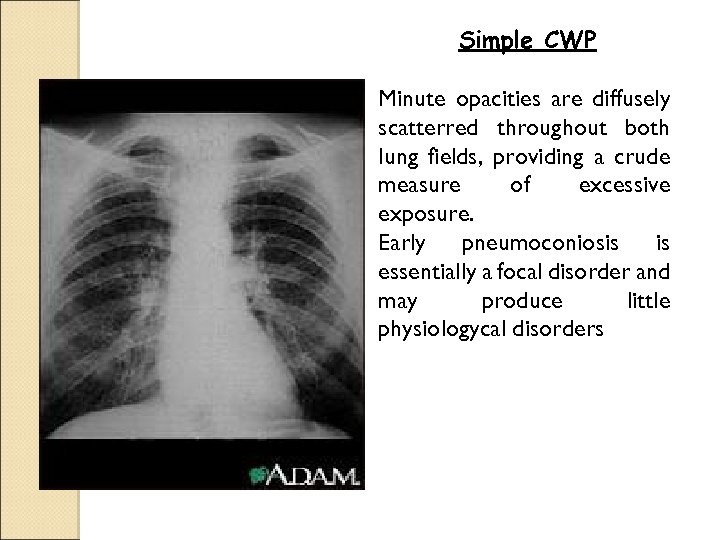 Simple CWP Minute opacities are diffusely scatterred throughout both lung fields, providing a crude