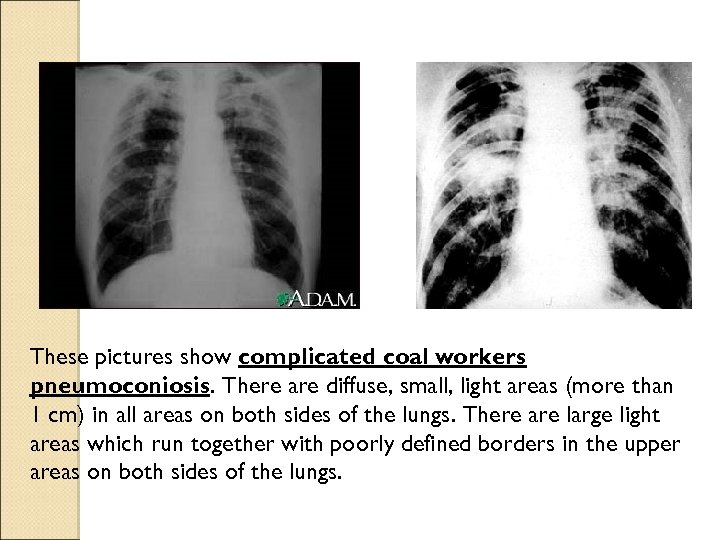 These pictures show complicated coal workers pneumoconiosis. There are diffuse, small, light areas (more