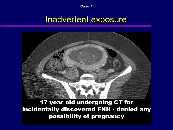 Case 1 Inadvertent exposure 17 year old undergoing CT for incidentally discovered FNH -