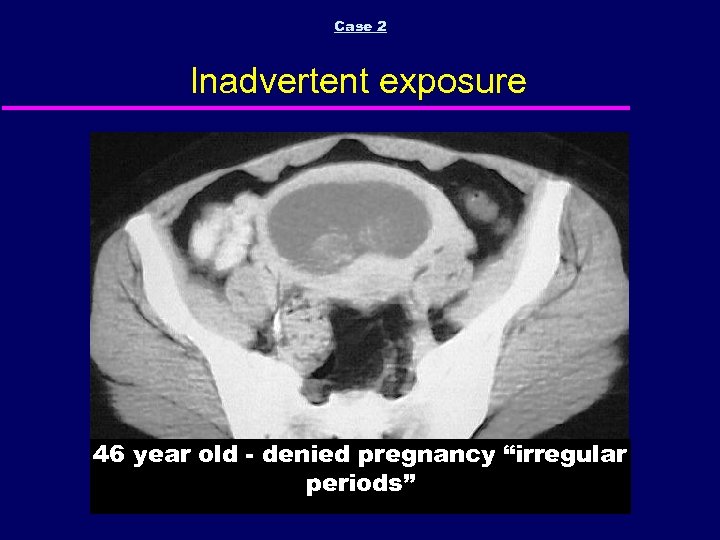 Case 2 Inadvertent exposure 46 year old - denied pregnancy “irregular periods” 