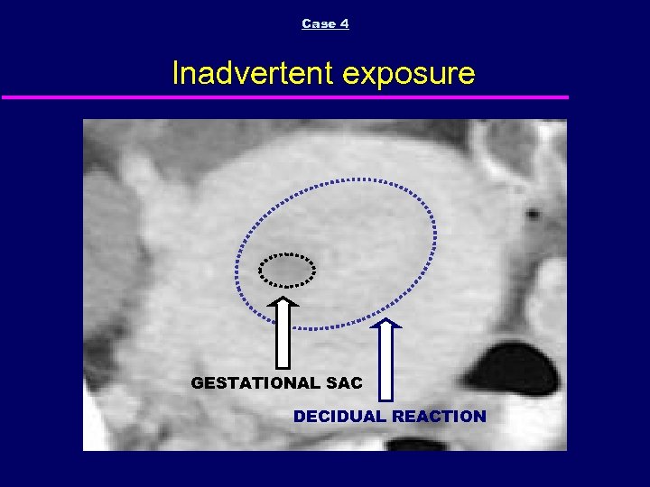 Case 4 Inadvertent exposure GESTATIONAL SAC DECIDUAL REACTION 