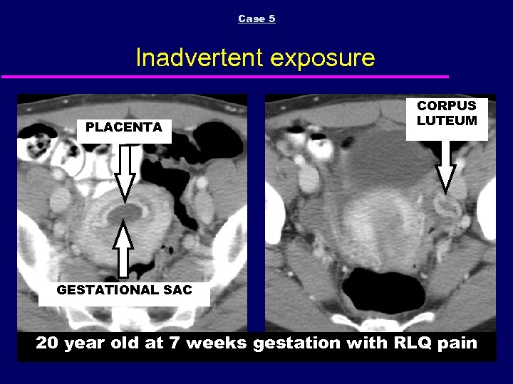 Case 5 Inadvertent exposure PLACENTA CORPUS LUTEUM GESTATIONAL SAC 20 year old at 7