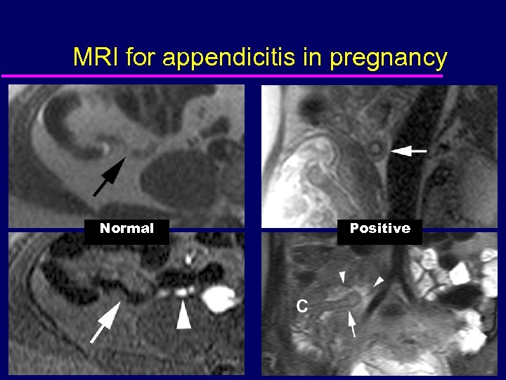 MRI for appendicitis in pregnancy Normal Positive 