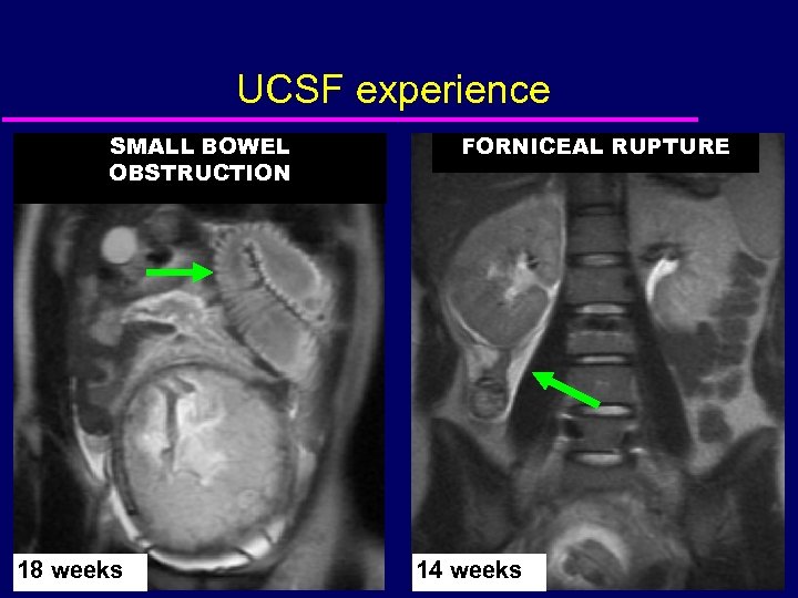 UCSF experience SMALL BOWEL OBSTRUCTION 18 weeks FORNICEAL RUPTURE 14 weeks 