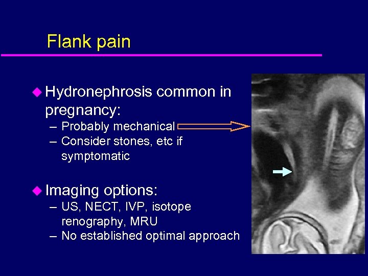 Flank pain u Hydronephrosis common in pregnancy: – Probably mechanical – Consider stones, etc