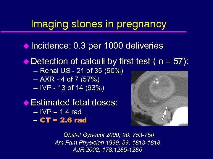 Imaging stones in pregnancy u Incidence: 0. 3 per 1000 deliveries u Detection of