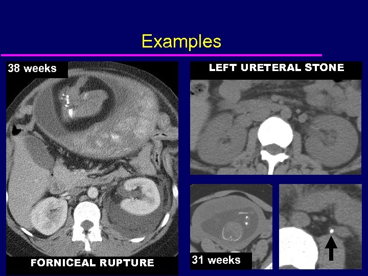 Examples 38 weeks FORNICEAL RUPTURE LEFT URETERAL STONE 31 weeks 