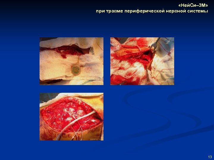  «Ней. Си– 3 М» при травме периферической нервной системы 13 