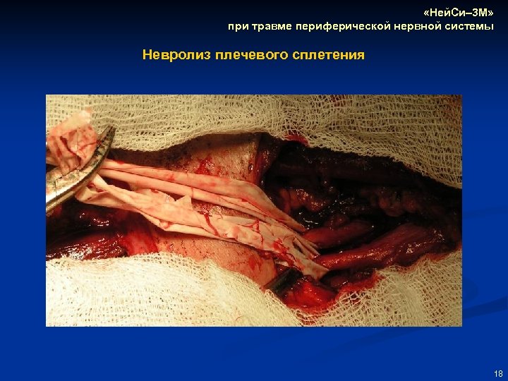  «Ней. Си– 3 М» при травме периферической нервной системы Невролиз плечевого сплетения 18