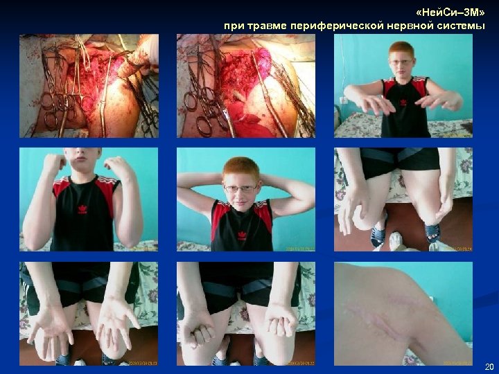  «Ней. Си– 3 М» при травме периферической нервной системы 20 