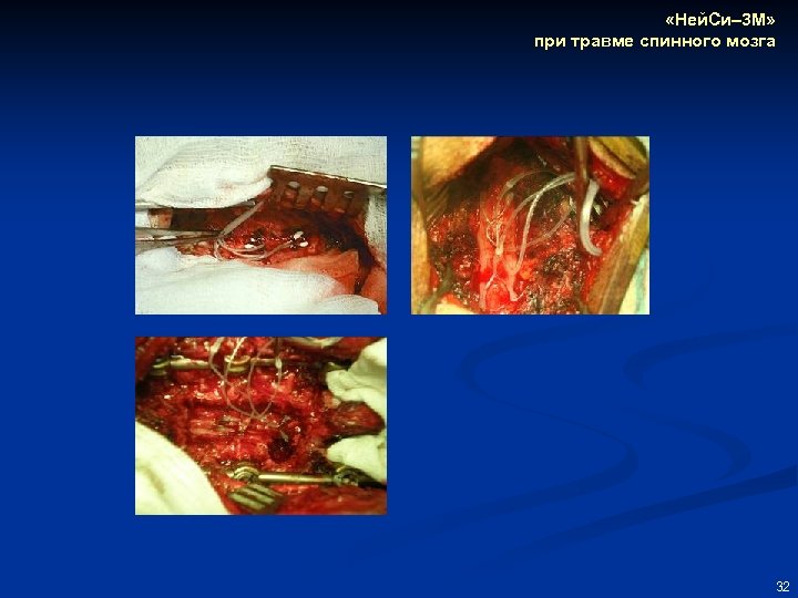  «Ней. Си– 3 М» при травме спинного мозга 32 