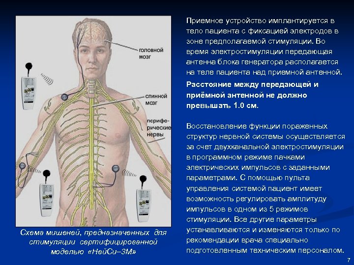 Приемное устройство имплантируется в тело пациента с фиксацией электродов в зоне предполагаемой стимуляции. Во