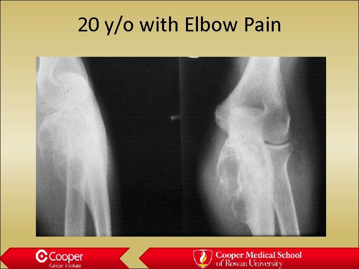 20 y/o with Elbow Pain 