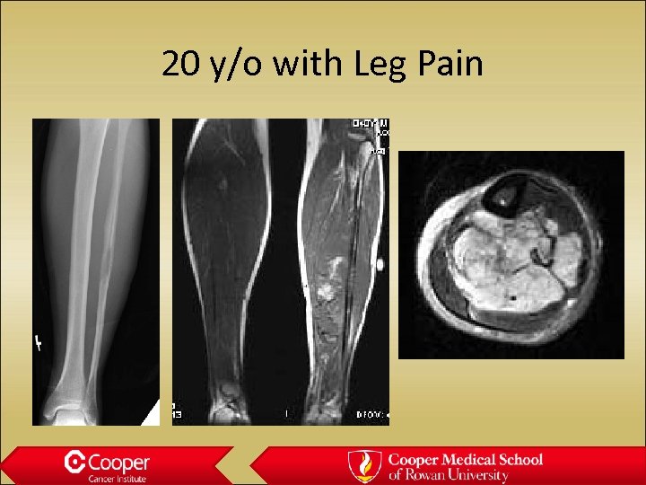 20 y/o with Leg Pain 