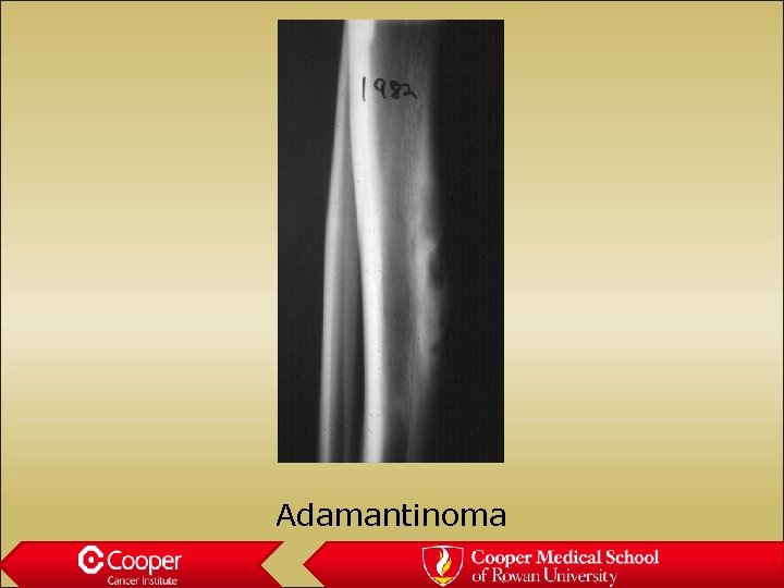 Adamantinoma 