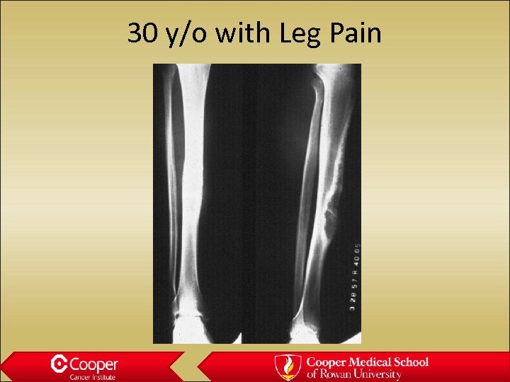 30 y/o with Leg Pain 