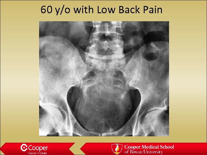 60 y/o with Low Back Pain 