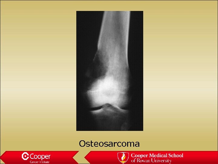 Osteosarcoma 