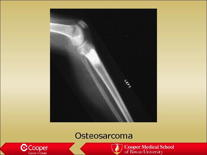 Osteosarcoma 