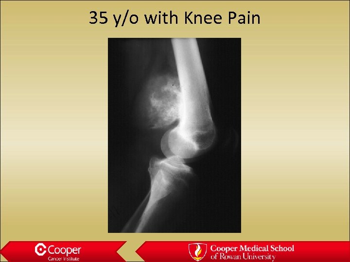 35 y/o with Knee Pain 