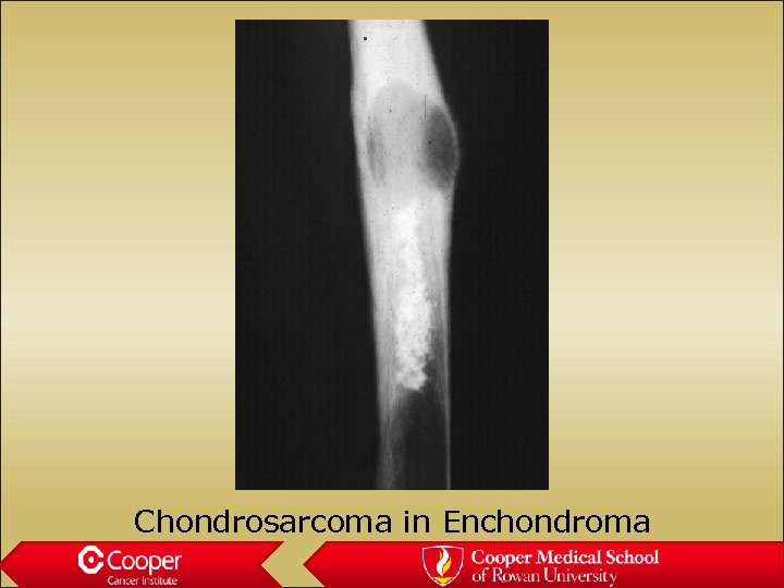 Chondrosarcoma in Enchondroma 