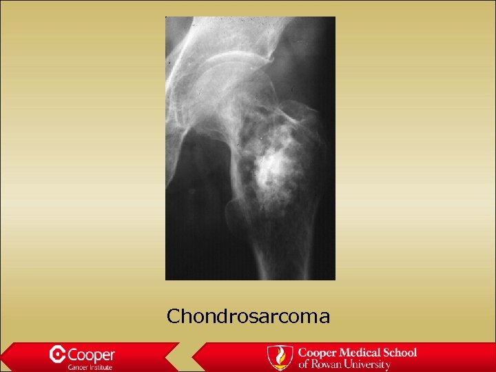 Chondrosarcoma 