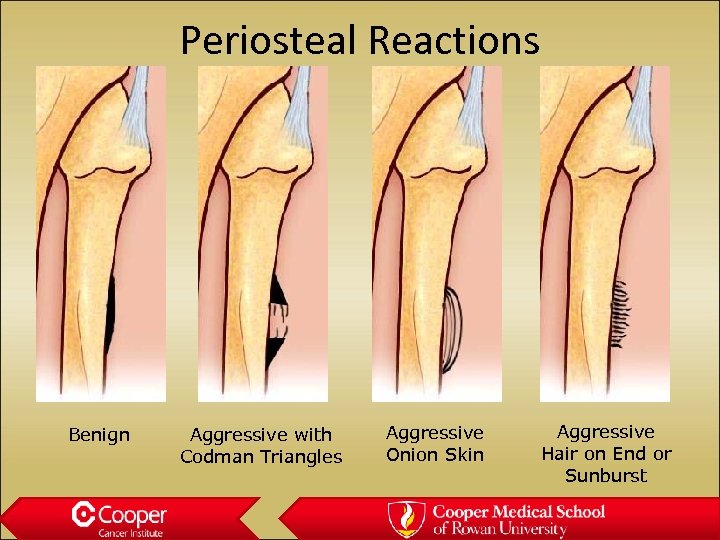 Periosteal Reactions Benign Aggressive with Codman Triangles Aggressive Onion Skin Aggressive Hair on End