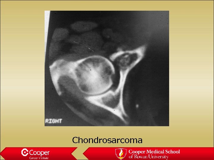 Chondrosarcoma 