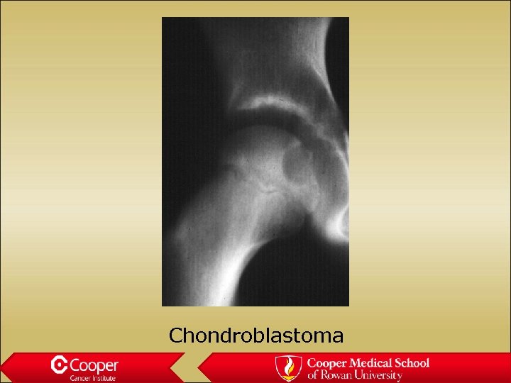 Chondroblastoma 