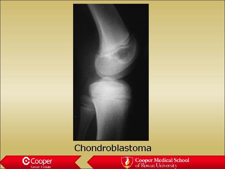 Chondroblastoma 