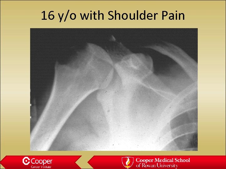 16 y/o with Shoulder Pain 