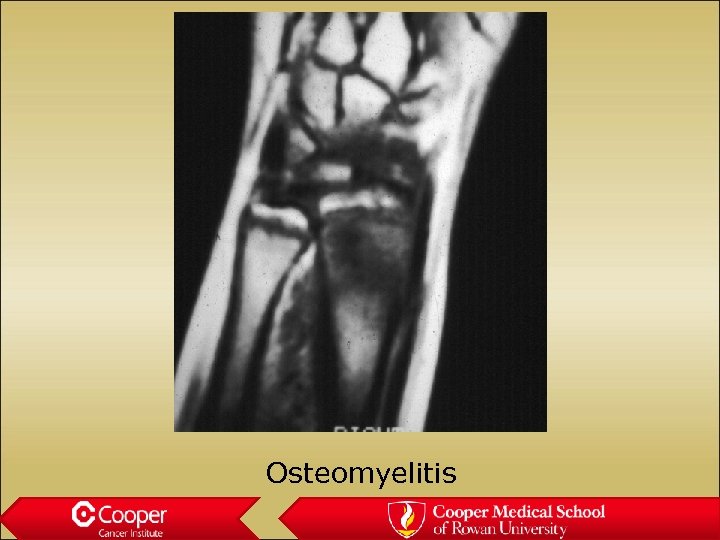 Osteomyelitis 