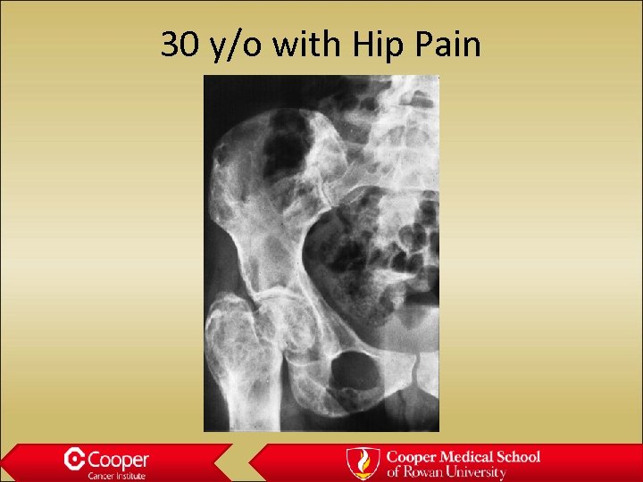 30 y/o with Hip Pain 