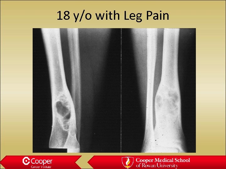 18 y/o with Leg Pain 