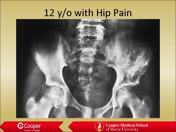 12 y/o with Hip Pain 