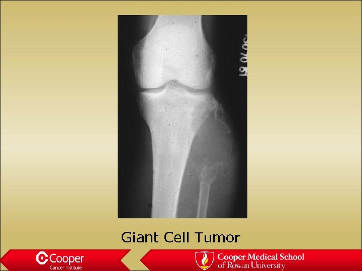 Giant Cell Tumor 