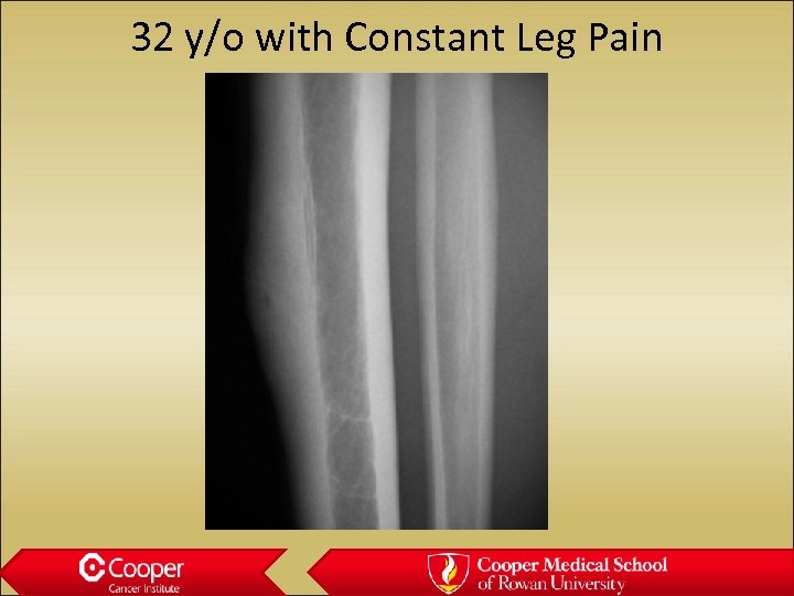 32 y/o with Constant Leg Pain 