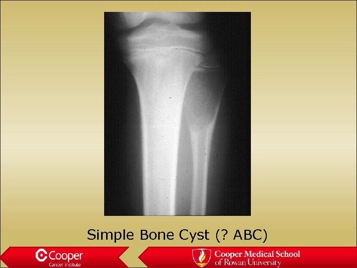 Simple Bone Cyst (? ABC) 