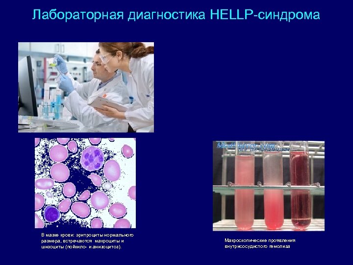 Лабораторная диагностика HELLP-синдрома В мазке крови: эритроциты нормального размера, встречаются макроциты и шизоциты (пойкило-