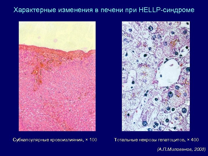 Характерные изменения в печени при HELLP-синдроме Субкапсулярные кровоизлияния, × 100 Тотальные некрозы гепатоцитов, ×