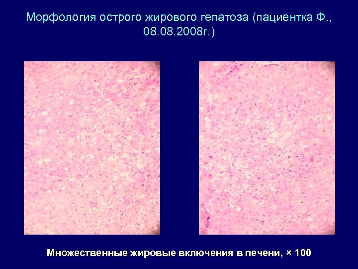 Морфология острого жирового гепатоза (пациентка Ф. , 08. 2008 г. ) Множественные жировые включения