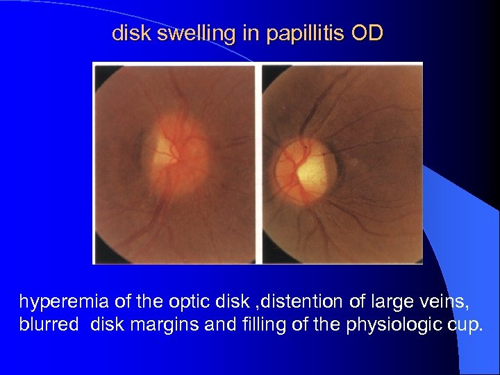 disk swelling in papillitis OD hyperemia of the optic disk , distention of large