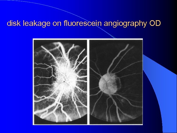 disk leakage on fluorescein angiography OD 