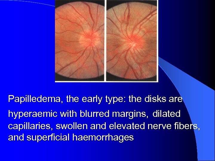 Papilledema, the early type: the disks are hyperaemic with blurred margins, dilated capillaries, swollen