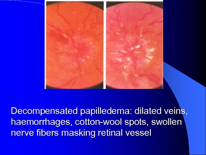 Decompensated papilledema: dilated veins, haemorrhages, cotton-wool spots, swollen nerve fibers masking retinal vessel 